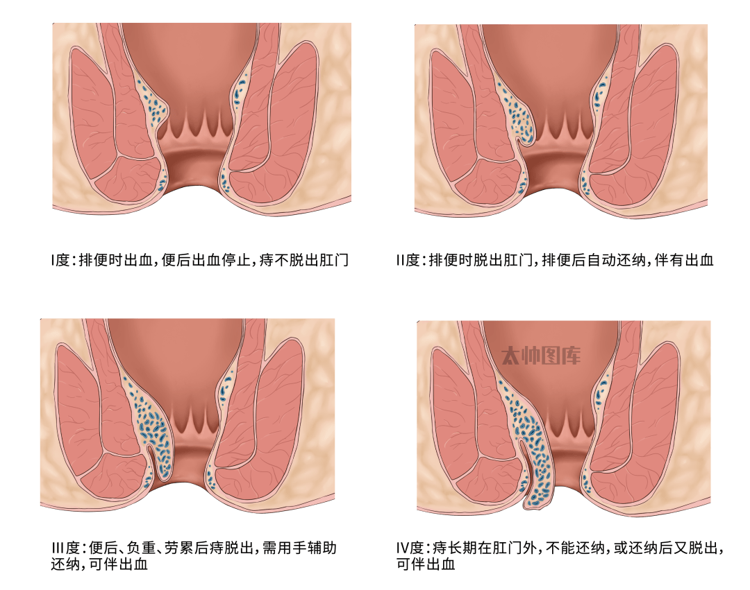 图片来源于太帅图库临床上把痔疮大体分为内痔
