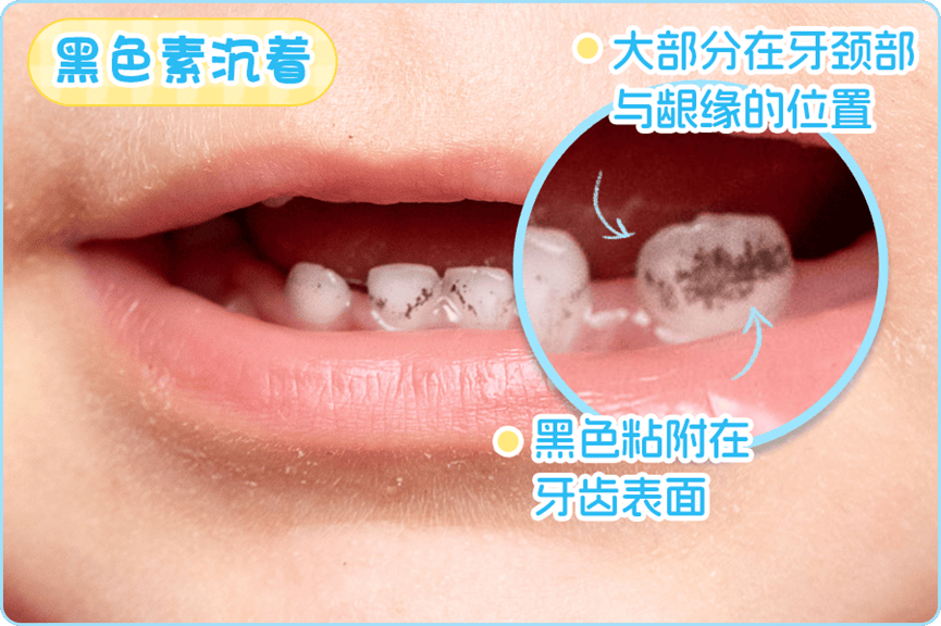 医生:再拖就真的晚了_牙齿_奥乐_脱矿
