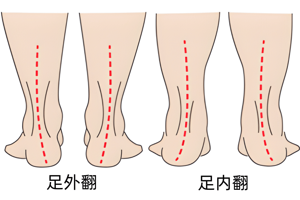 足内翻图解图片