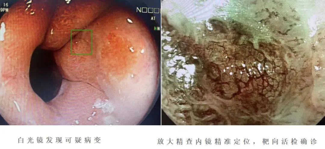 【友谊消化窥镜】消化道早癌"扑朔迷离",放大内镜"明察秋毫"