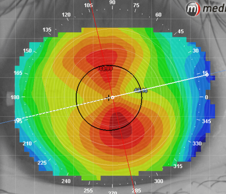 如何理解运用角膜地形图的轴向图？_散光_曲率_表面