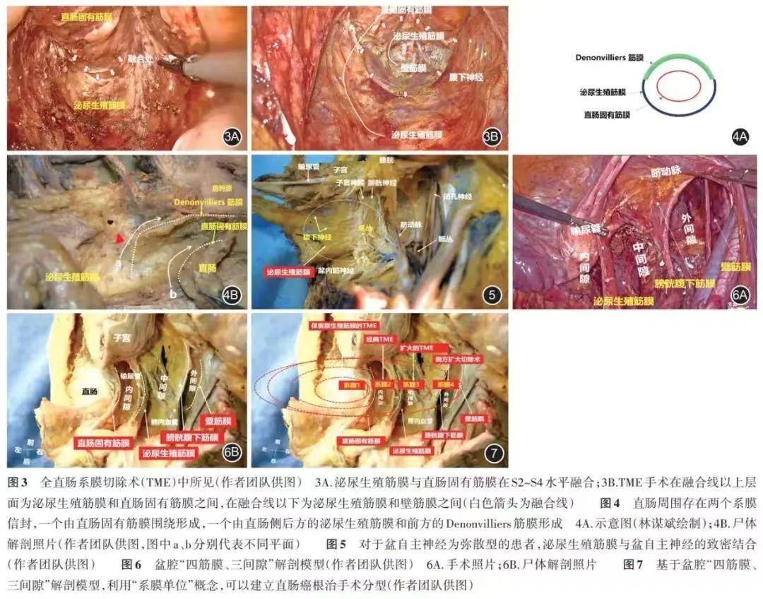 膜解剖--推动盆腹腔手术新飞跃