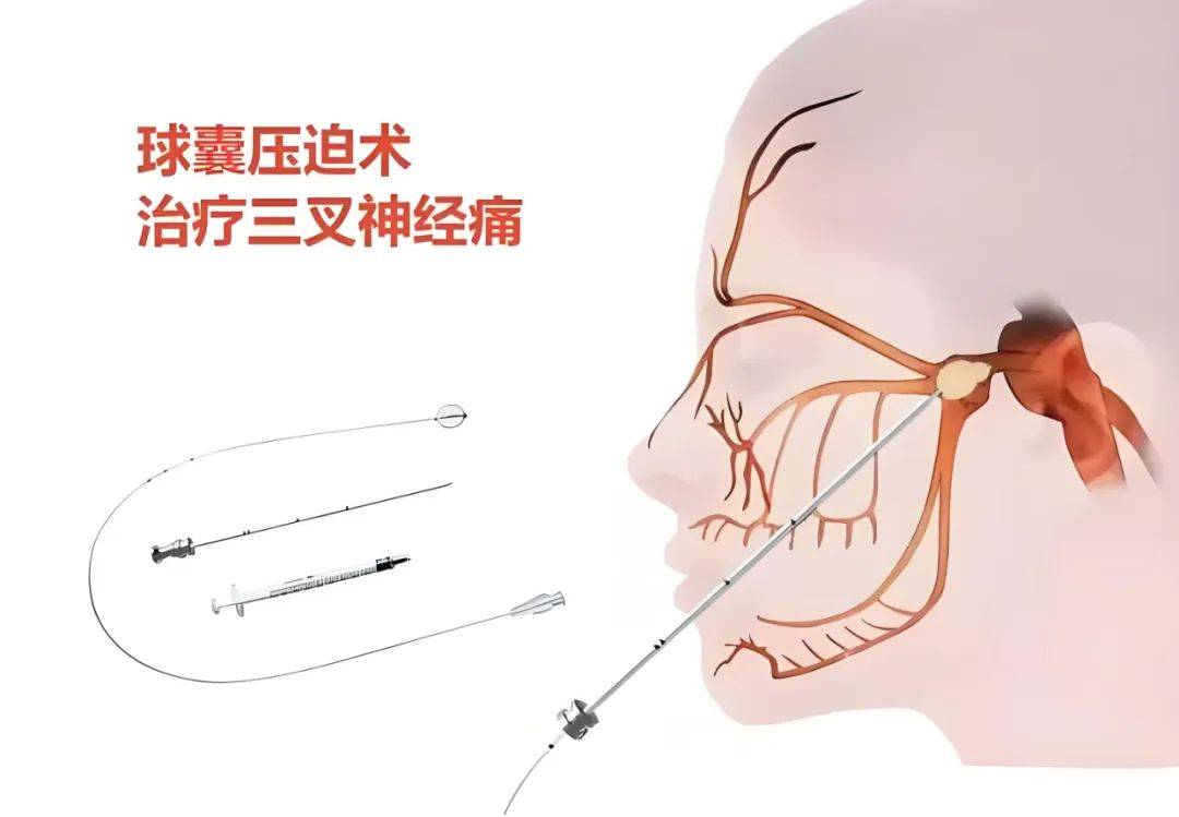 微创治疗三叉神经痛!摆脱面部阵发性的刀割样,针刺样,火烧样疼痛