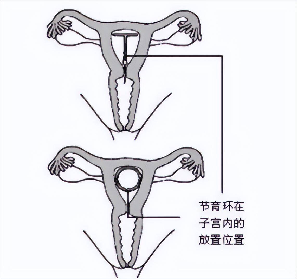 这些因素都可能影响到节育环的佩戴和取出