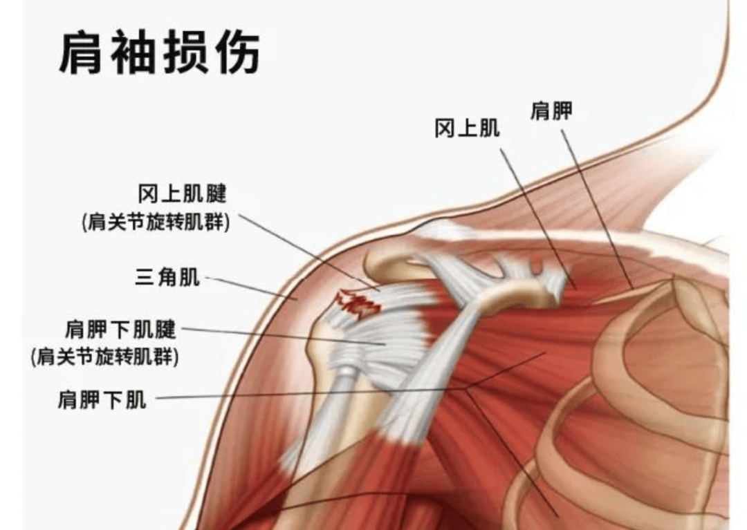 肩袖炎疼痛位置的图片图片