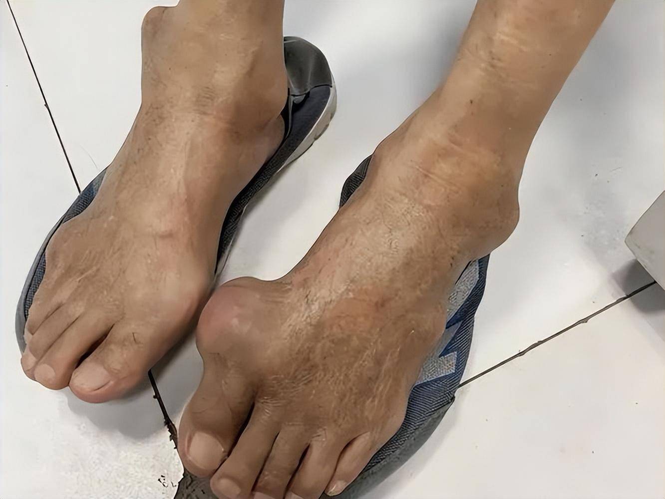 痛风病人能不能吃?医生一文解释清楚