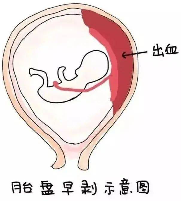 前置胎盘胎盘早剥图片