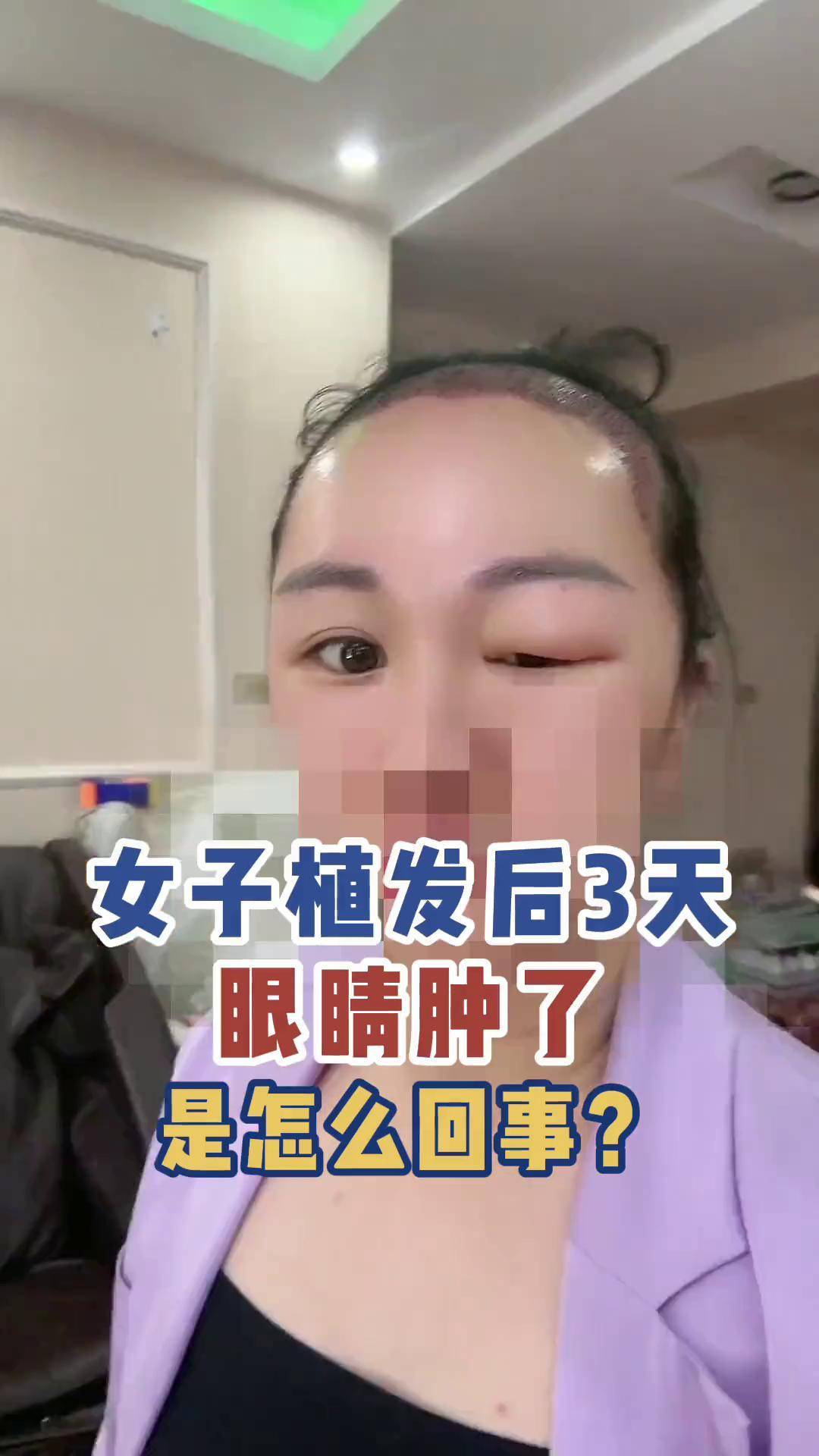 植发后下午晚上肿了(植发后下午晚上肿了怎么回事)