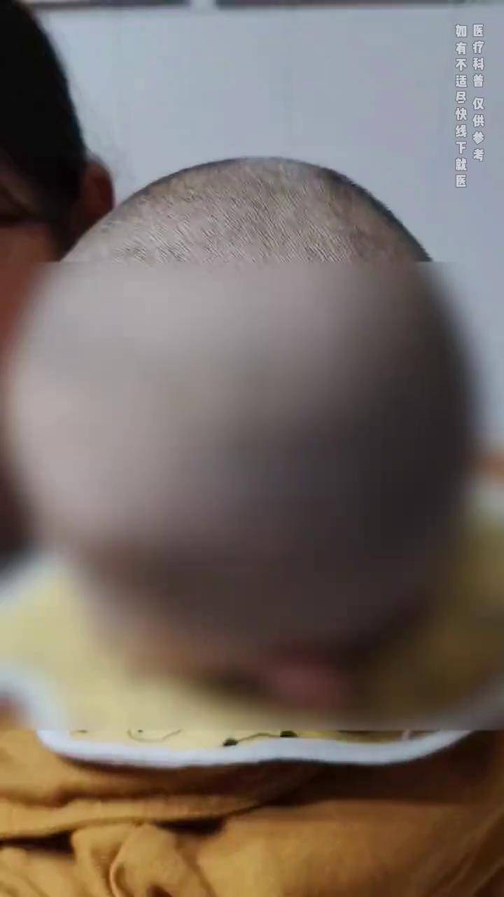 宝宝随妈妈两个额头没有长起来双侧冠状缝早闭颅缝