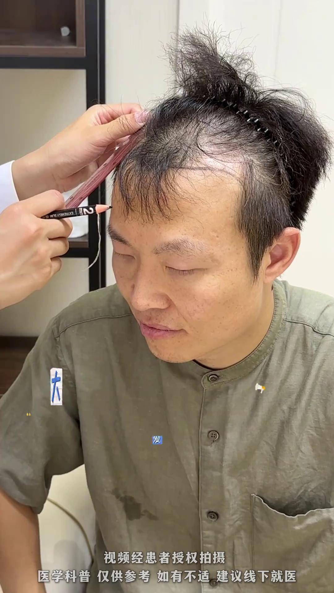 植发手术浪费毛囊吗(植发手术浪费毛囊吗知乎)