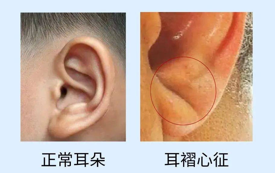 千万警惕动脉硬化或冠心病的发生或许是"耳褶心征"的表现但小编知道
