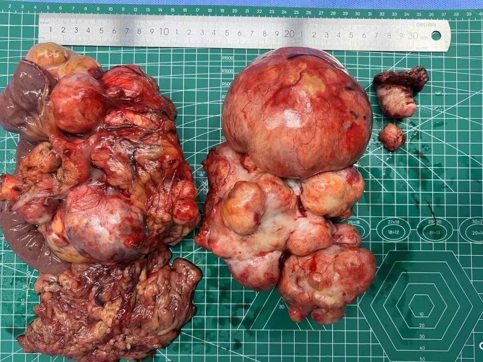 瑞金病例丨重4kg,直径达30cm的巨大肿瘤被顺利"拆弹"!