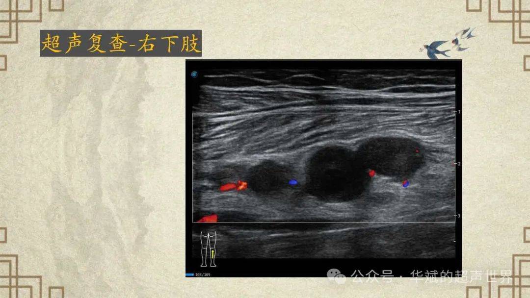 下肢动脉闭塞超声图片