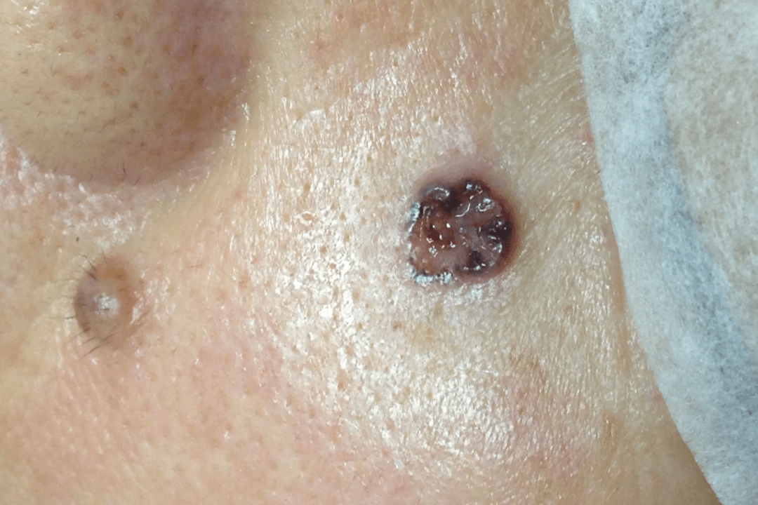 术后病理检查提示为交界痣