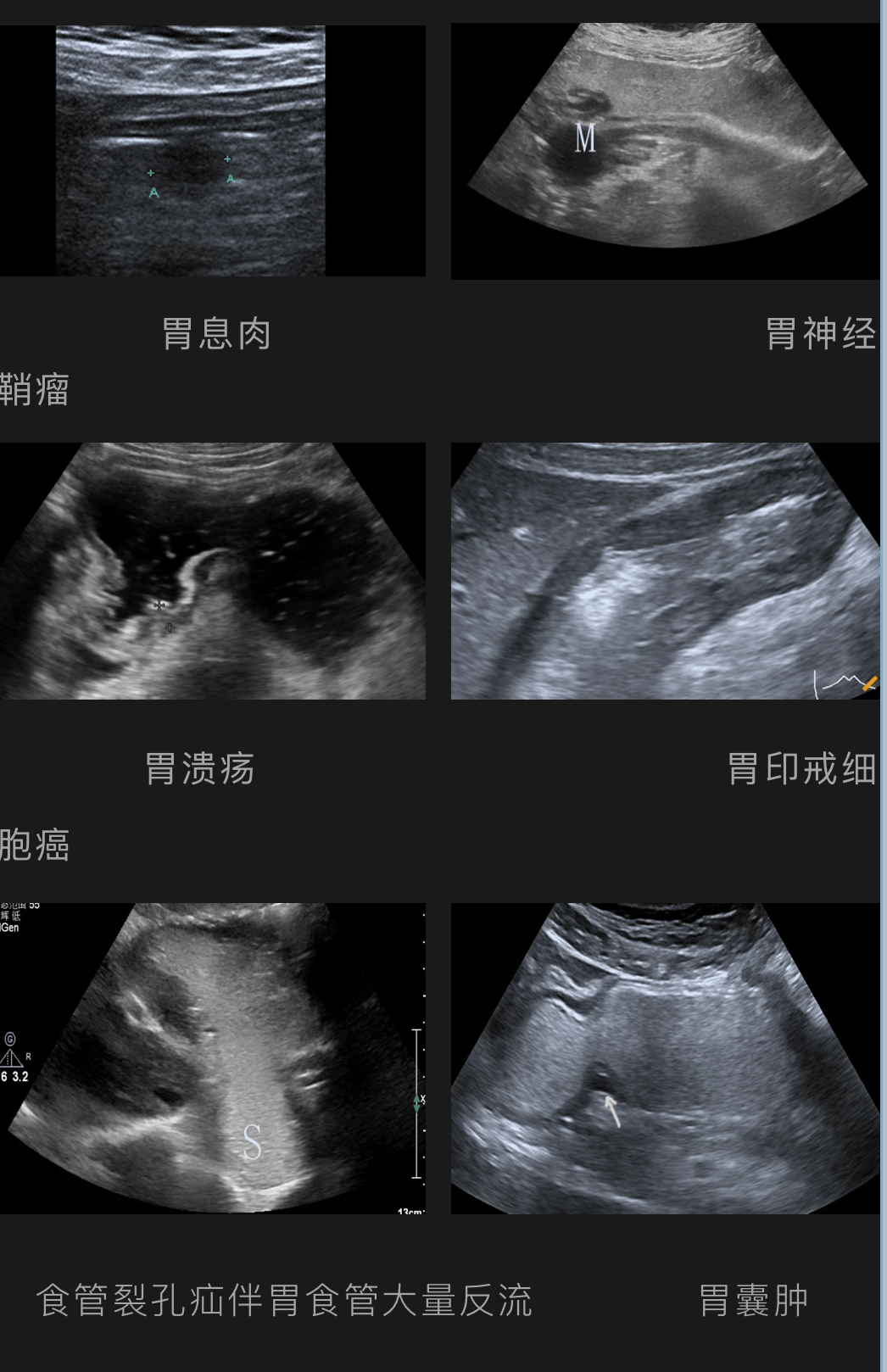 胃间质瘤超声图片