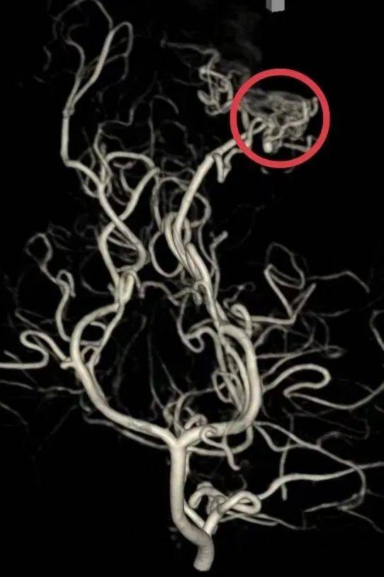 小脑蚓部血管畸形图片