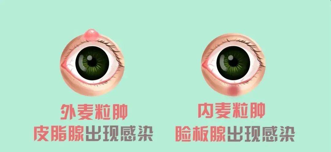 【五彩童年 健康同行】如何预防治疗麦粒肿 ——崂山区育才学校（小学部）_孩子_眼睑_毛巾
