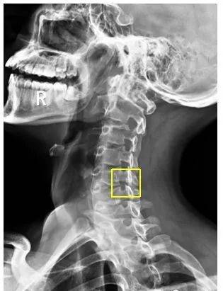 颈椎DR解剖图片