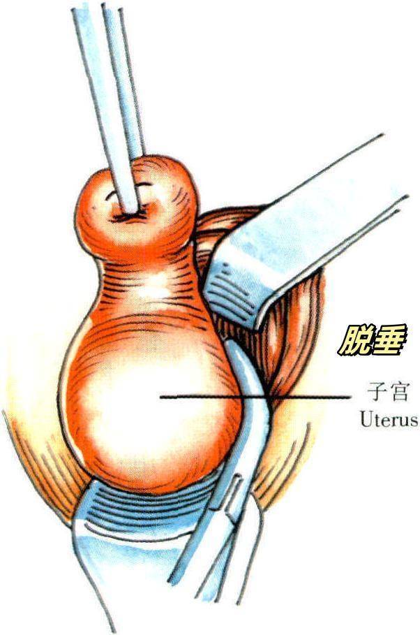 顺产后感觉下面毁了图片