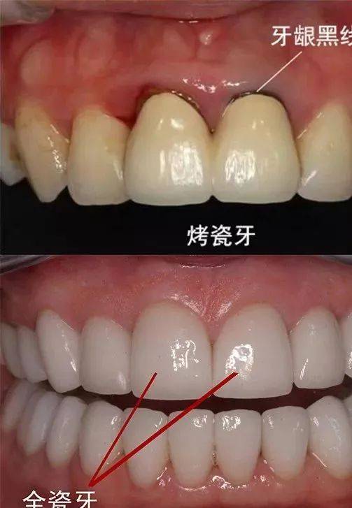 全口假牙佩戴图片对比图片