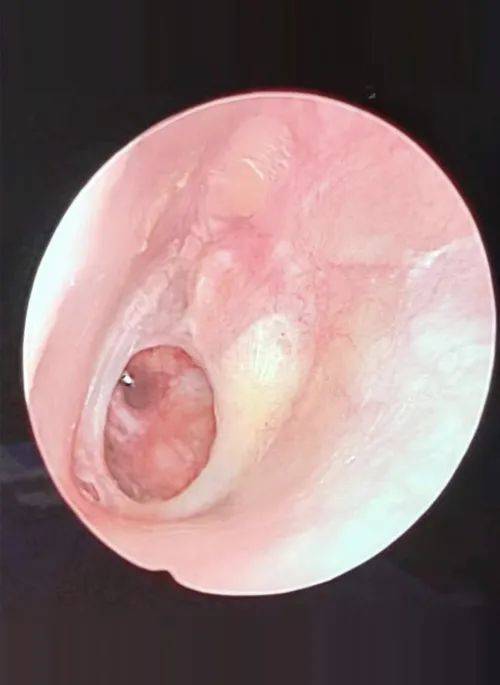 耳膜穿孔手术图片