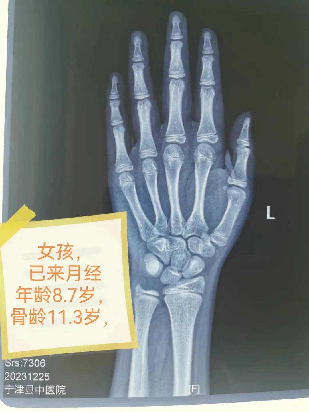 宁津县中医院儿童什么情况下要测骨龄