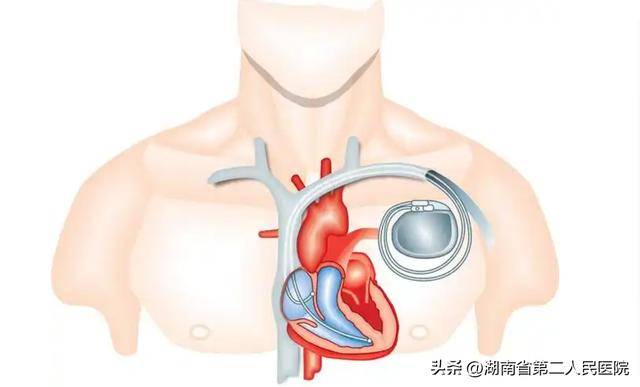 起搏器位置图片图片