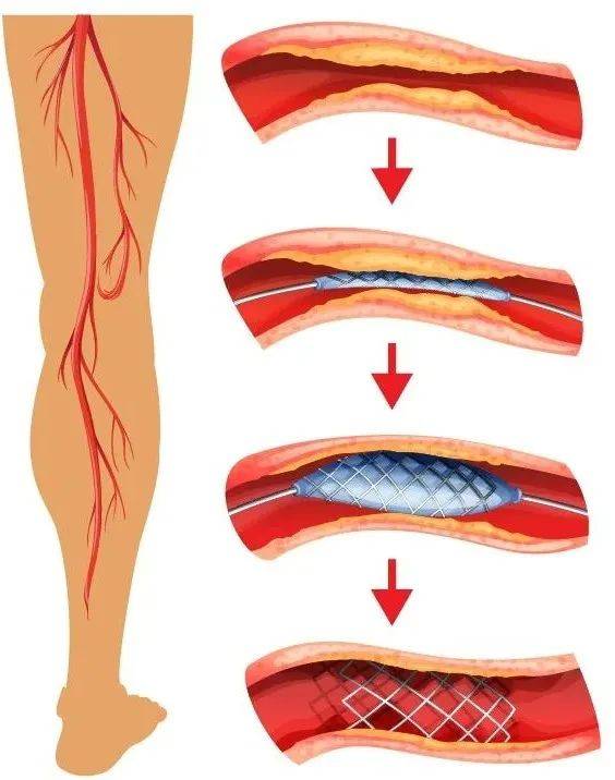 双下肢动脉硬化图片图片