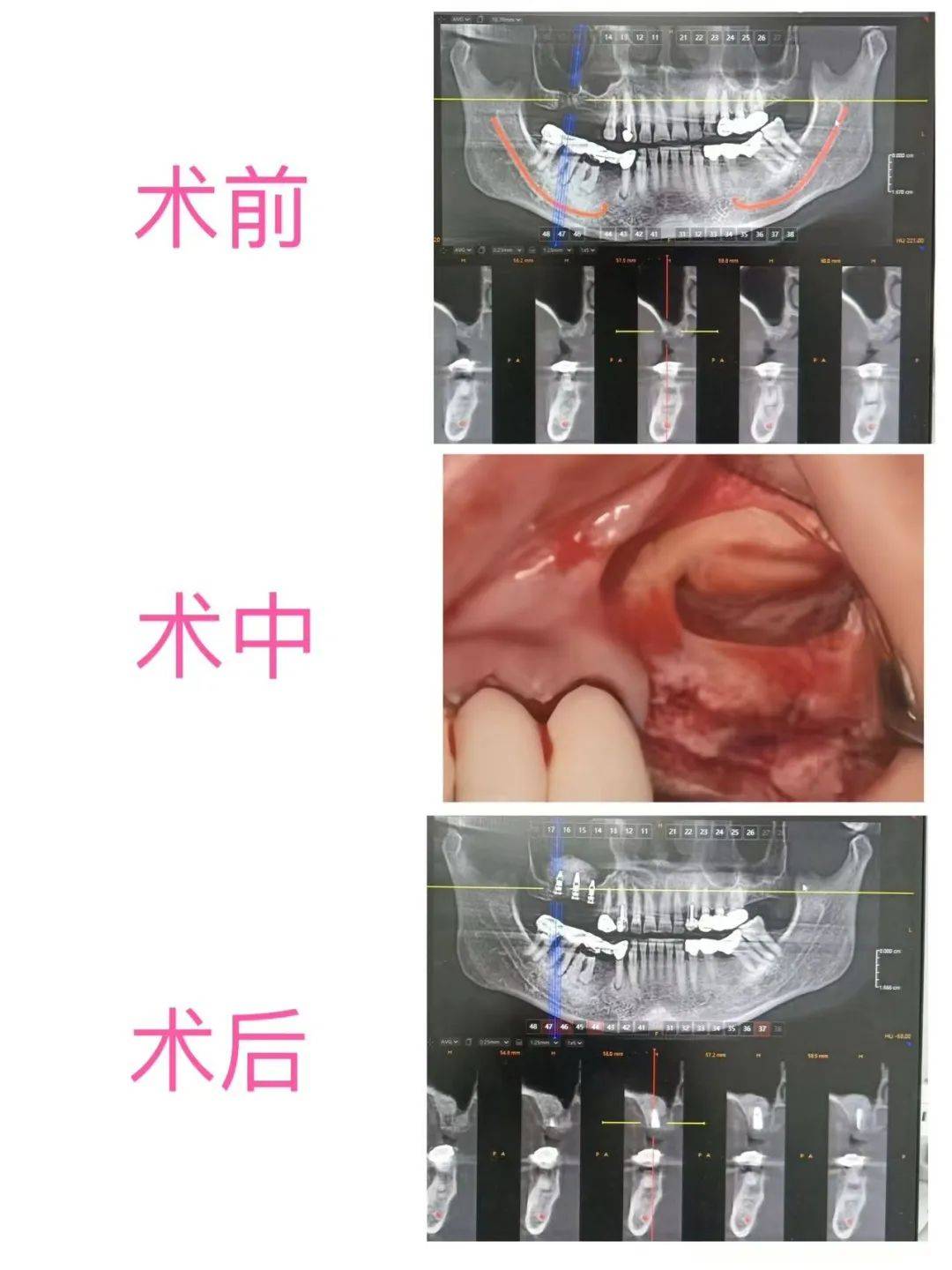 上颌腭隆突图片图片