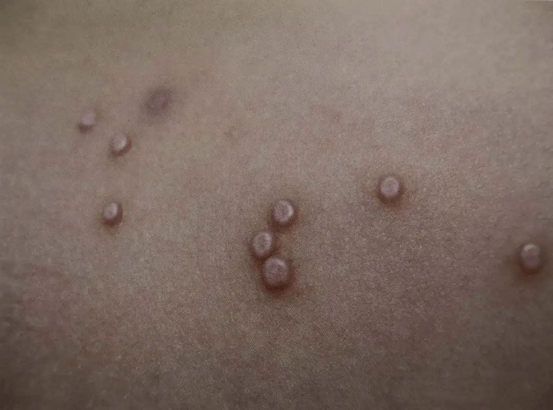 身上长的肉疙瘩,到底是个啥?