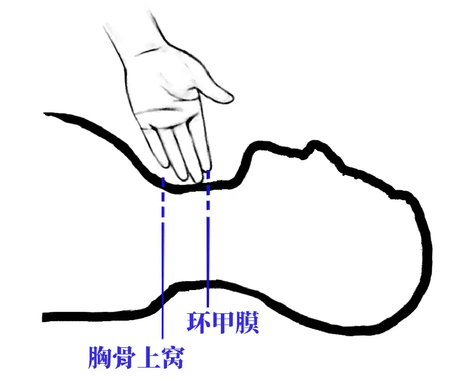 实用技术 | 环甲膜穿刺实用定位技巧
