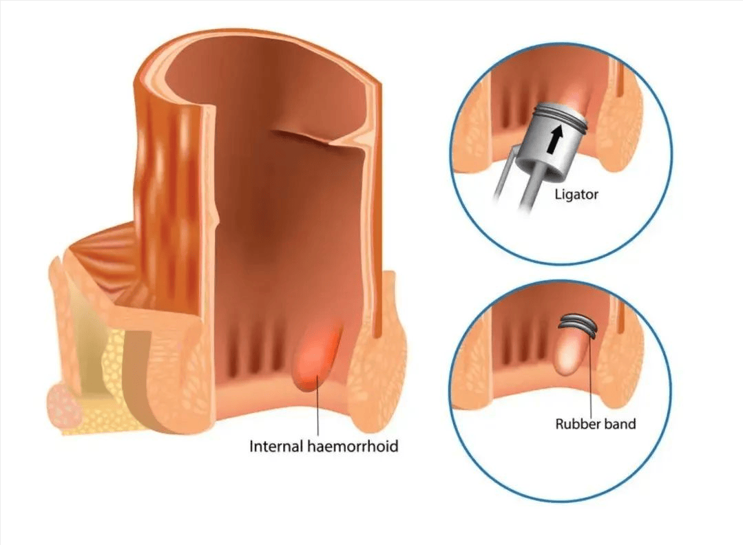 痔疮套扎手术图解图片