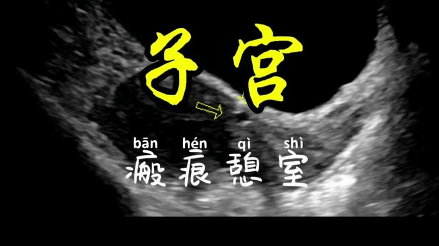 生完孩子月经淋漓8,9天,妇科b超查出子宫长了这个!