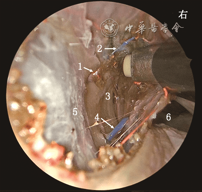 短篇论著 | 带蒂鼻中隔黏膜瓣静脉系统的解剖学研究及其在鼻颅底修复