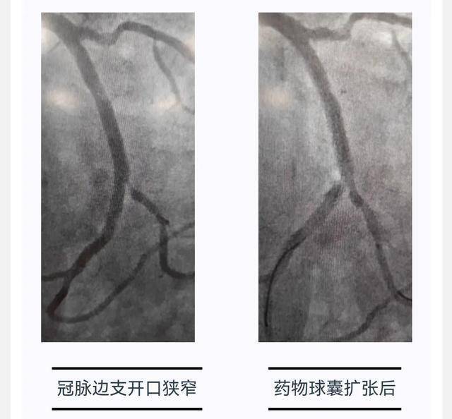 冠状动脉球囊扩张术图片