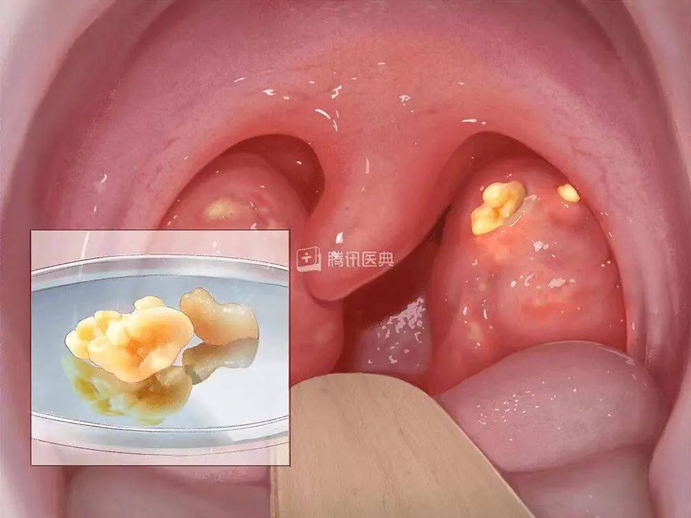 软腭菜花状瘤图片