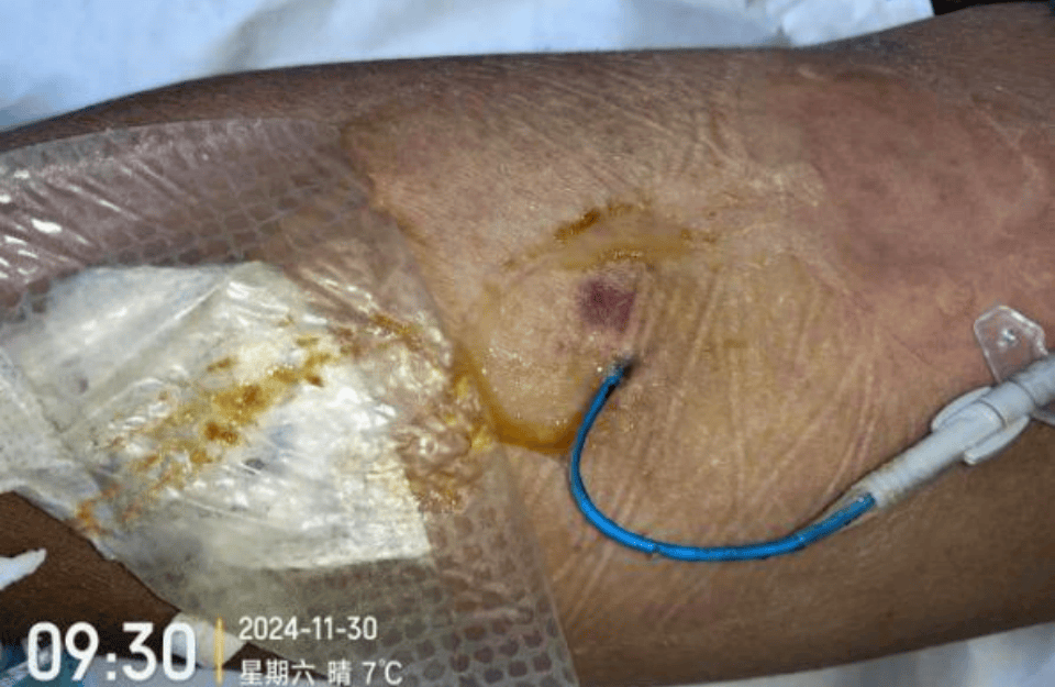 picc 置管术后并发淋巴渗液怎么办?