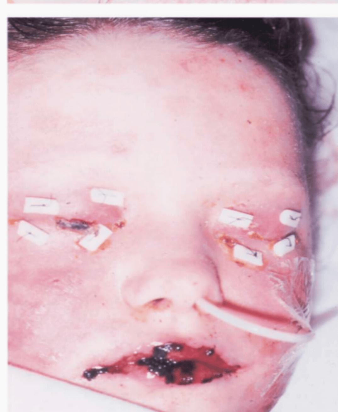 皮肤_治疗_病变