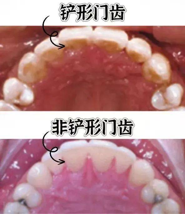 门牙背面图片