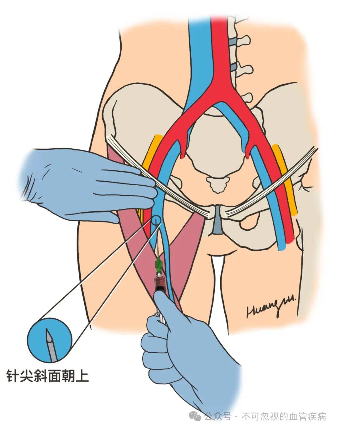 股静脉定位方法示意图图片