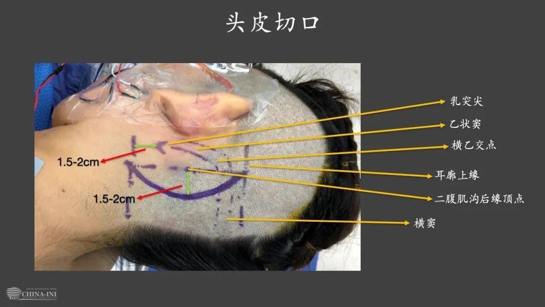 乙状窦后入路切口设计图片