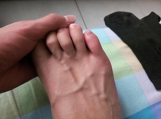 体内有血栓,看脚就知道?提醒:若出现这几种表现,或是血管堵了