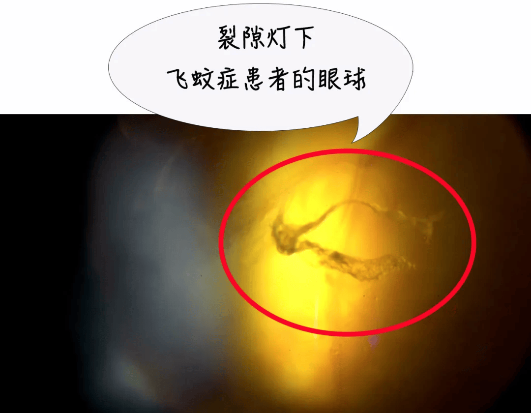 眼前出现"飞蚊"该怎么办?