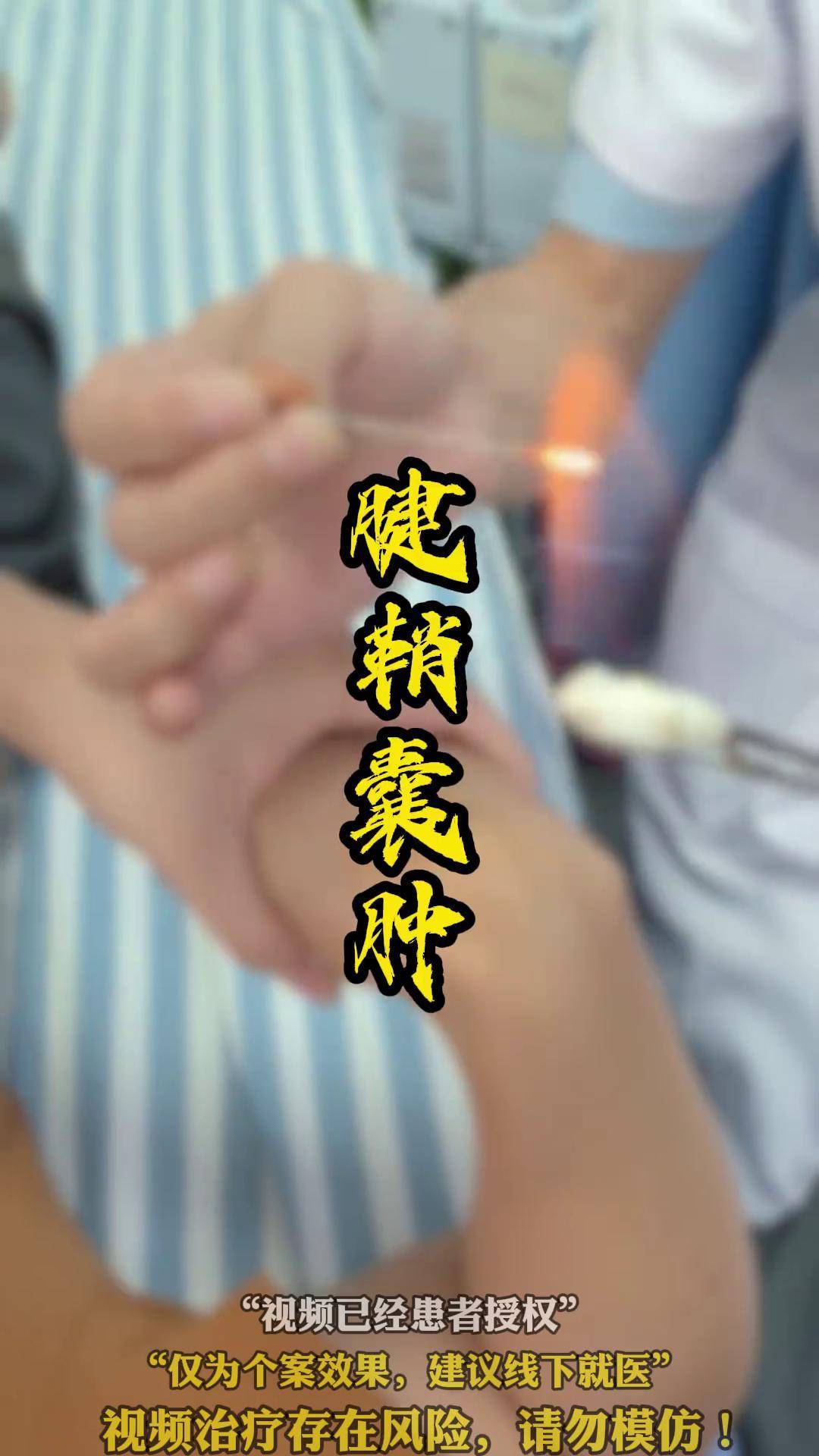 腱鞘囊肿 中医 针灸调理 中医蔡主任