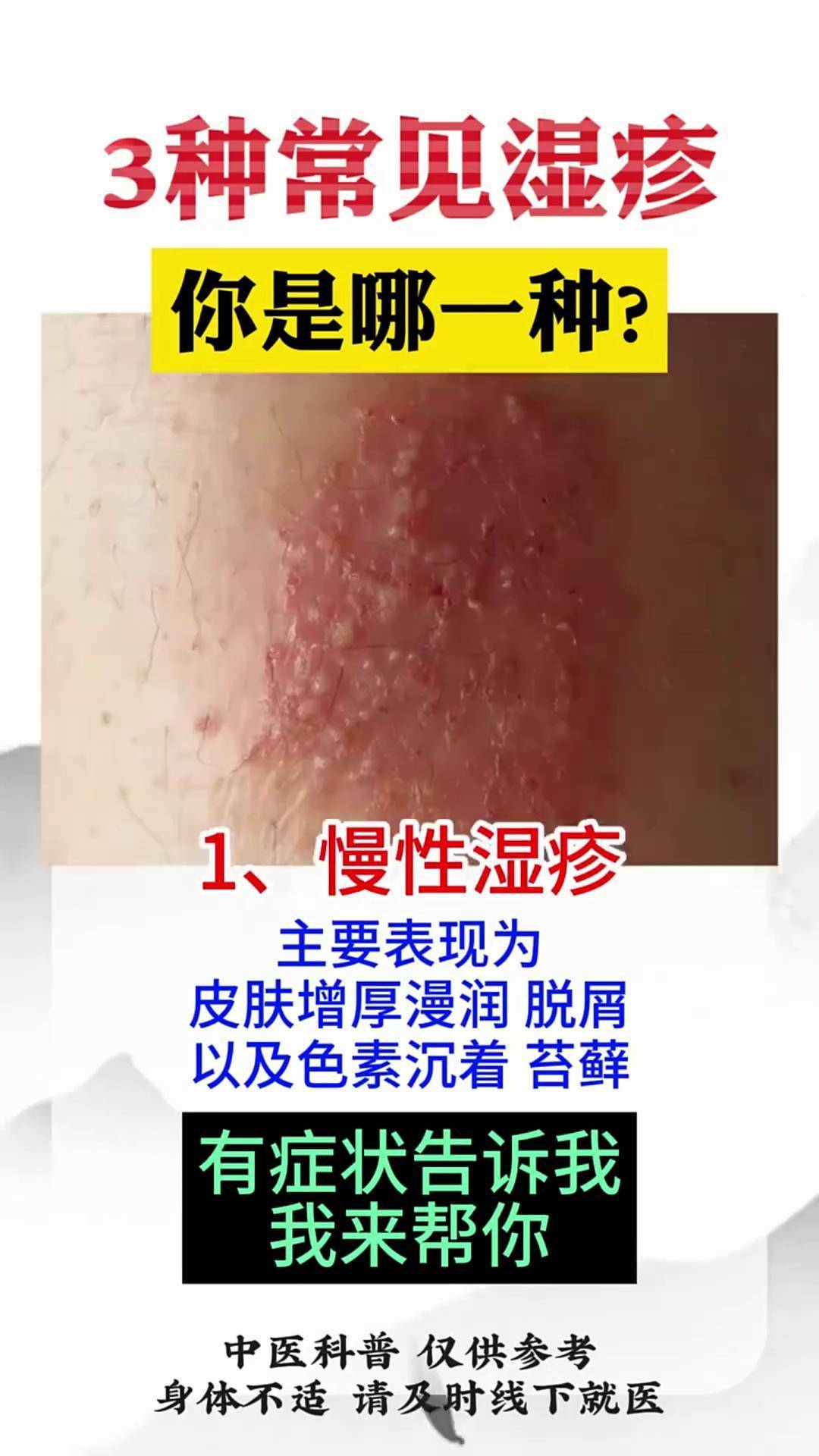 婴儿为什么有湿疹为什么在线 婴儿为什么有湿疹为什么在线