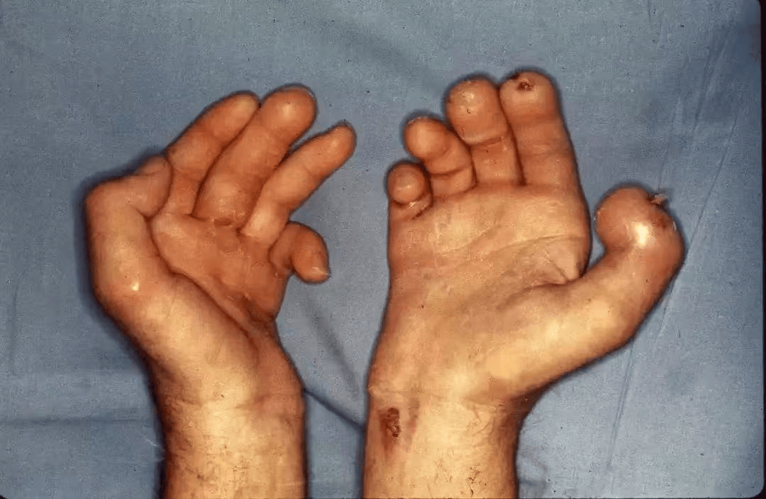 麻风病康复:科学治疗与心灵疗愈并重