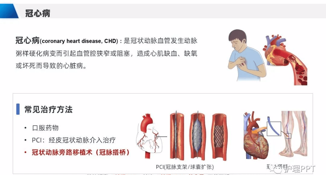 【ppt】冠脉搭桥患者护理查房（cabg）