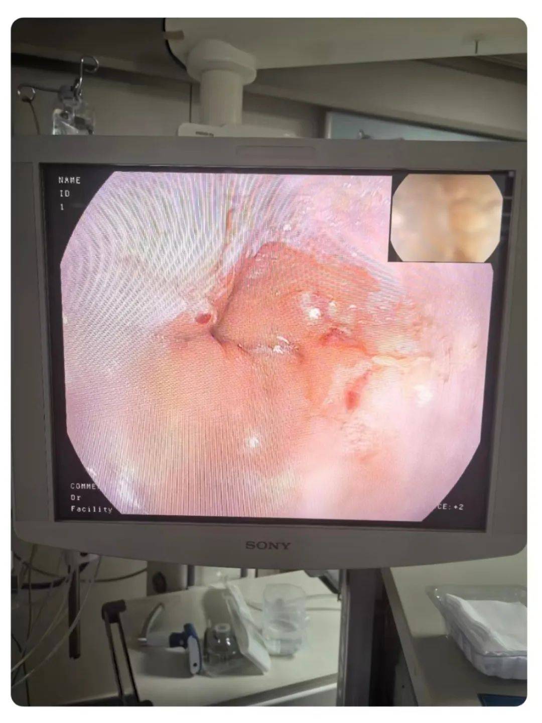 患者院外呕血多次到区中心医院急诊科呕血1200ml血压最低降至79/63