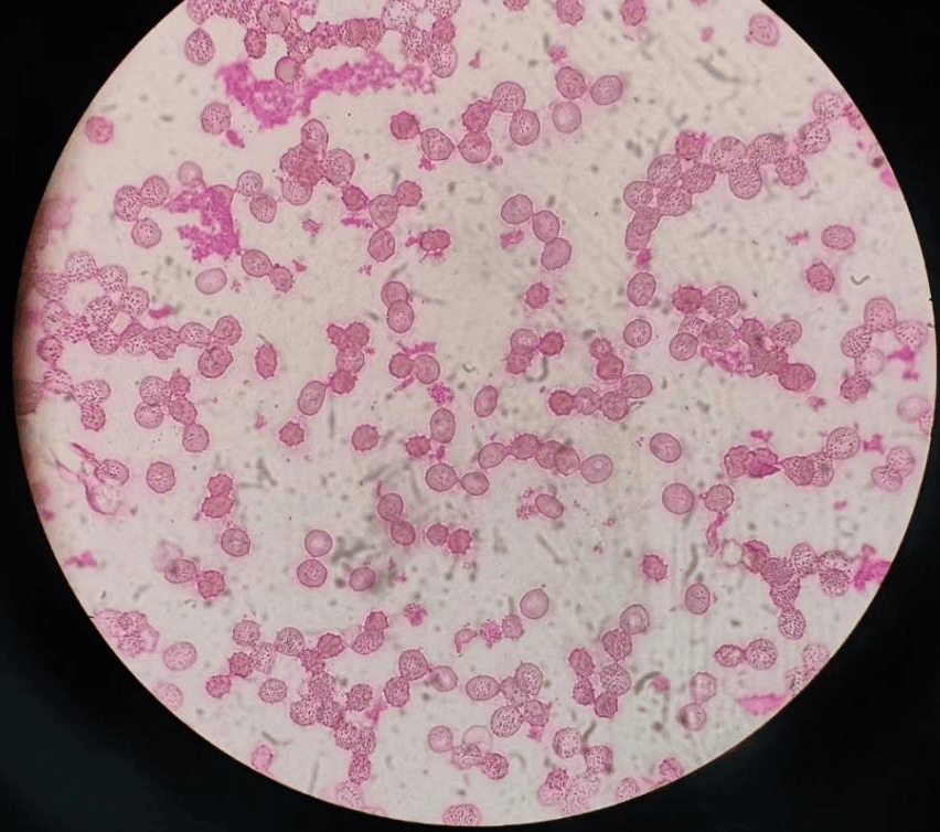 一布鲁氏菌感染病例分享及实验室诊断