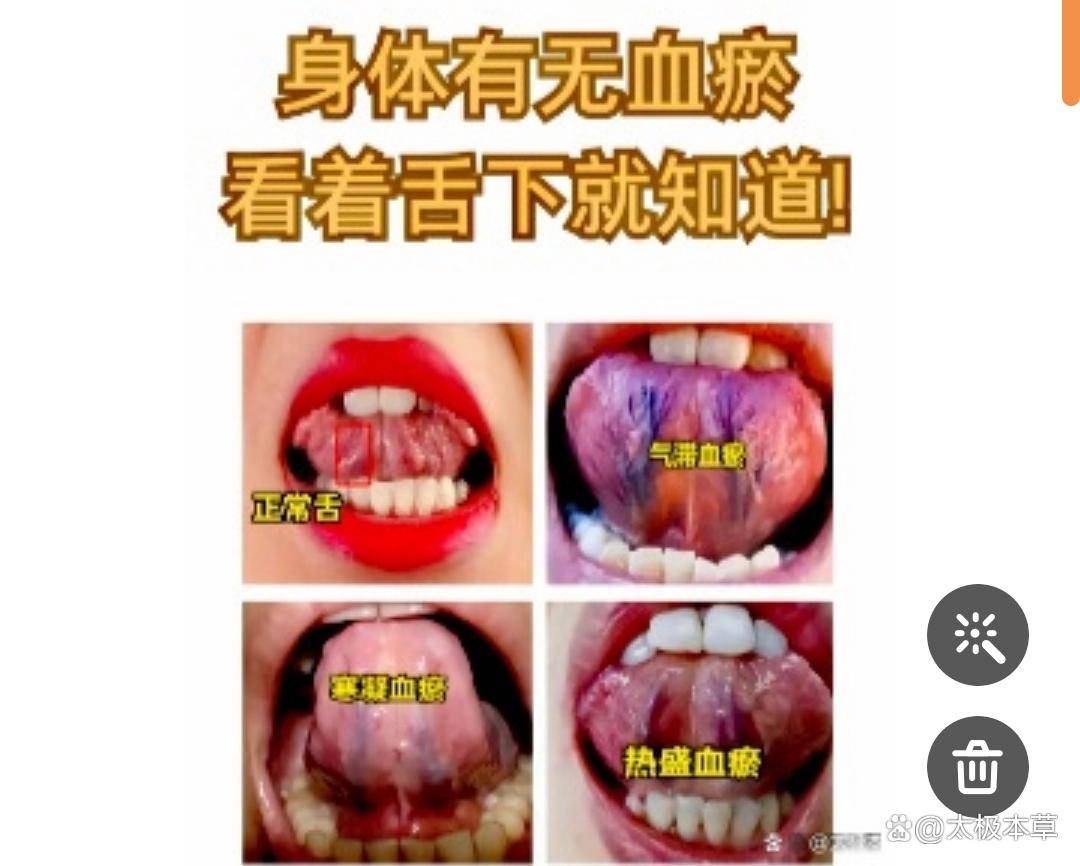 如何根据舌下“青筋”颜色辩证_身体_气血_情况